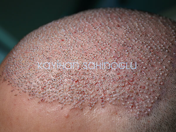 Hair Transplant Turkey Surgery Dr. Kayihan Sahinoglu