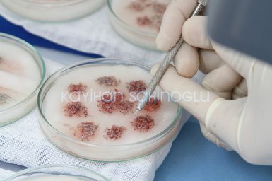 Storing The Follicular Units - Dr. Kayihan Sahinoglu | Hair Transplant Surgeon