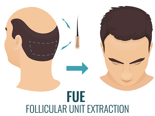 FUE (Follicular Unit Extraction) hair transplant surgery - FUE Hair Transplant | Dr. Kayihan Sahinoglu | Turkey