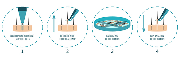 FUE Hair Transplant Procedure | Dr. Kayihan Sahinoglu | Turkey