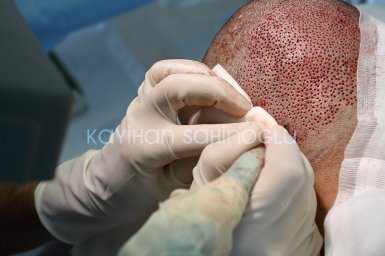 Hair Transplant Turkey Surgery Dr. Kayihan Sahinoglu