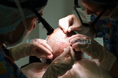 Hair Transplant Turkey Surgery Dr. Kayihan Sahinoglu - Transplantation Of The Follicular Units
