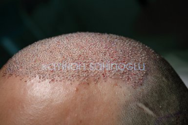 Hair Transplant Turkey Surgery Dr. Kayihan Sahinoglu