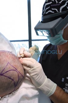 Hair Transplant Turkey Surgery Dr. Kayihan Sahinoglu