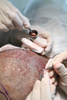 Hair Transplant Turkey Surgery Dr. Kayihan Sahinoglu