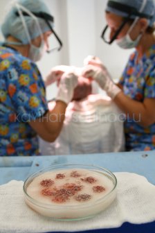 Hair Transplant Turkey Surgery Dr. Kayihan Sahinoglu