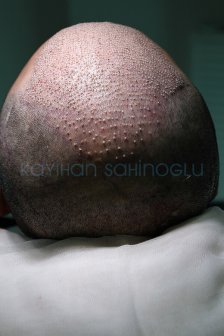 Hair Transplant Turkey Surgery Dr. Kayihan Sahinoglu