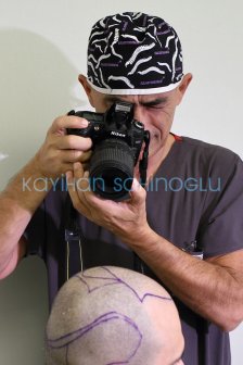 Dr. Kayihan Sahinoglu | Hair Transplant Surgeon