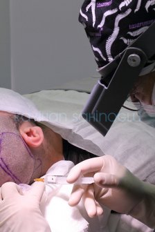 Hair Transplant Turkey Surgery Dr. Kayihan Sahinoglu