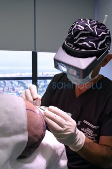 Hair Transplant Turkey Surgery Dr. Kayihan Sahinoglu