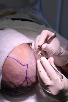 Hair Transplant Turkey Surgery Dr. Kayihan Sahinoglu