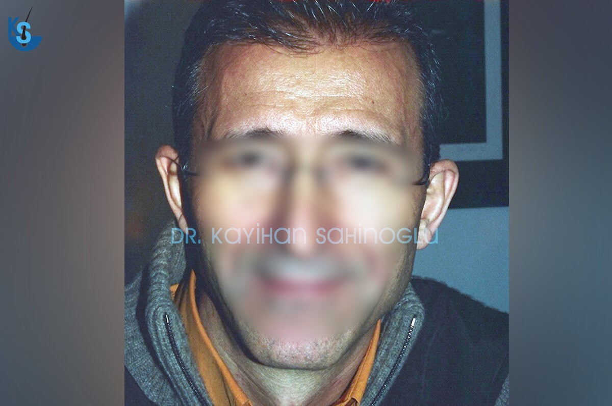 Hair Transplant Turkey Before After Dr. Kayihan Sahinoglu