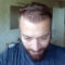 Hair Transplant Reviews Turkey I Dr. Kayihan Sahinoglu