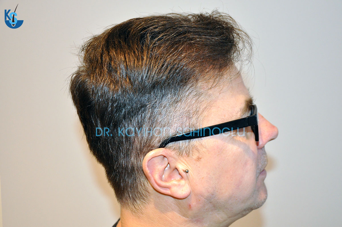 Hair Transplant Before After Photos - Get New Hair