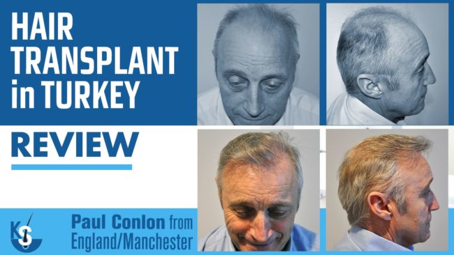 Hair Transplant Turkey Review
