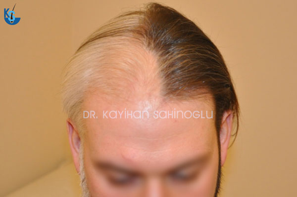 Hair Transplant Turkey Before After Dr. Kayihan Sahinoglu