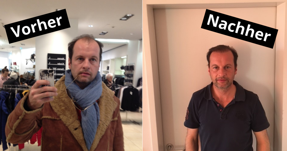 Hair Transplant Review Turkey