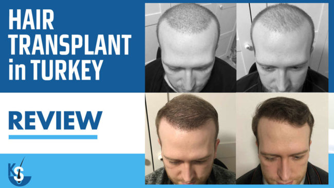 Hair Transplant Turkey Review - Dr. Kayihan Sahinoglu