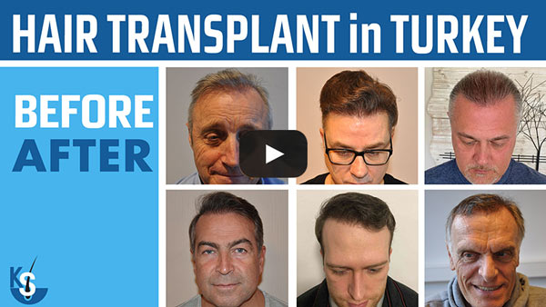 Hair Transplant in Turkey -Dr. Kayıhan Şahinoğlu